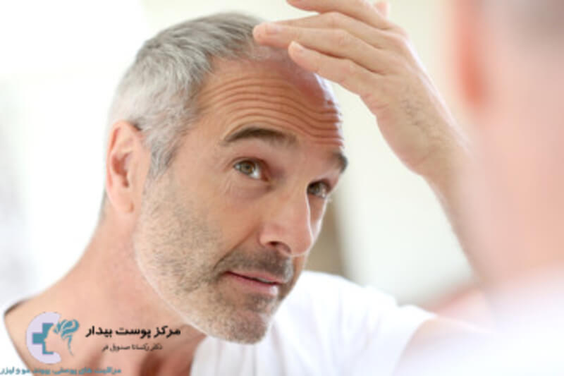 درمان ریزش مو با ماینوکسیدیل