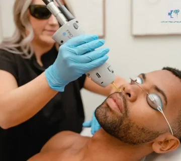 لیزر مو زائد