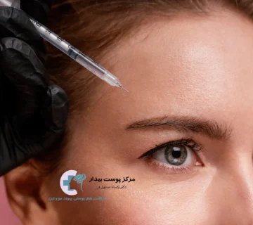 تزریق بوتاکس پیشانی
