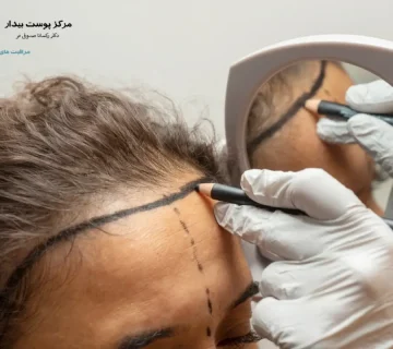 نتیجه کاشت مو