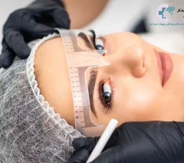 کاشت ابرو چیست