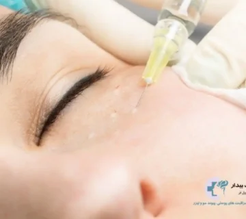 انواع مزوژل جوانساز